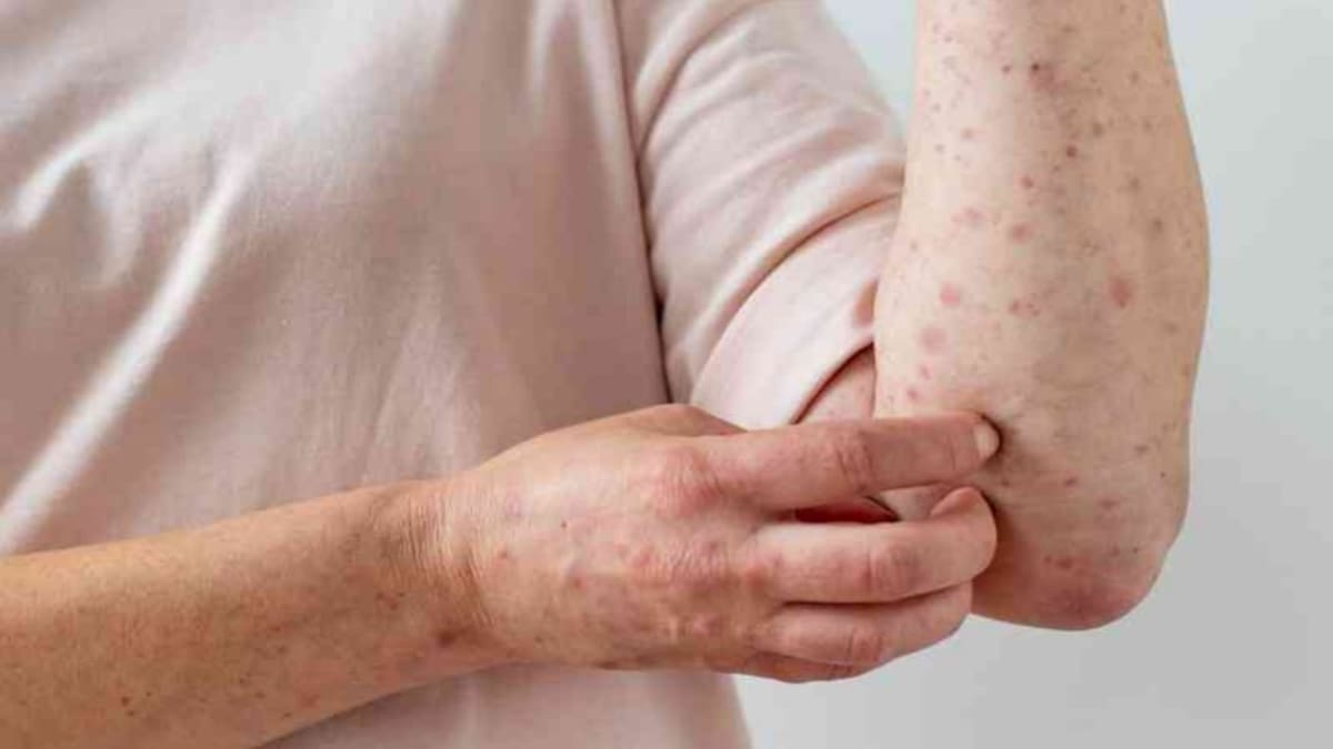 6 posibles casos de viruela del mono en Santander