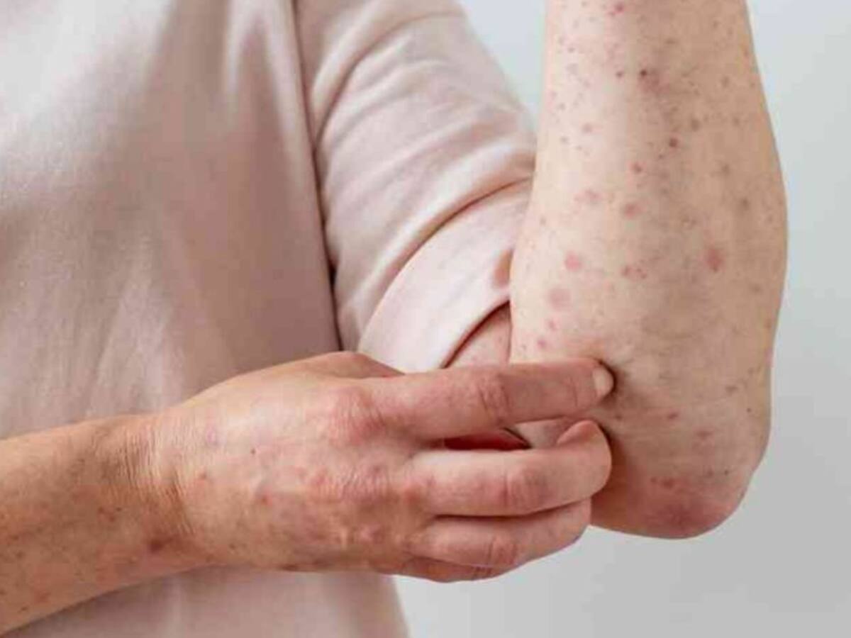 6 posibles casos de viruela del mono en Santander