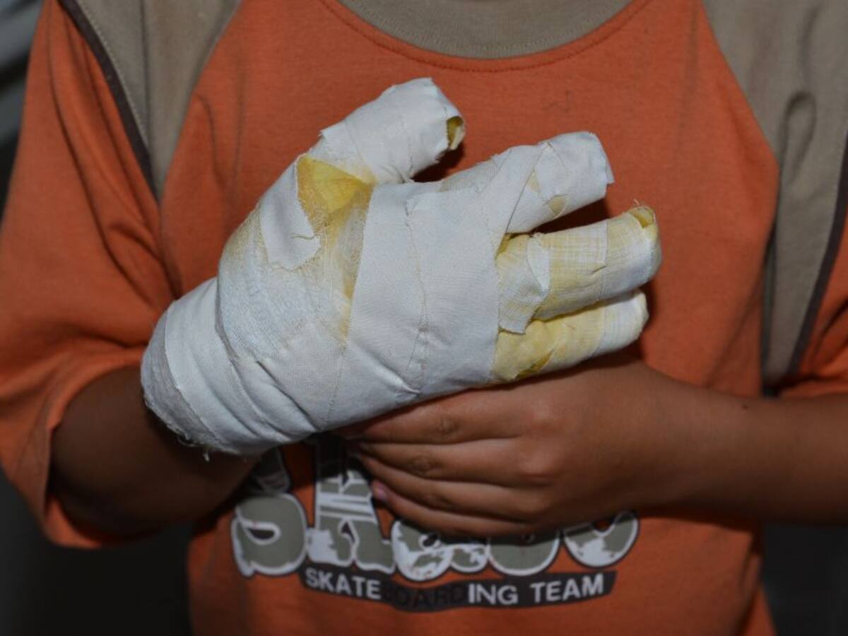 Reportan otro quemado con pólvora en el Magdalena