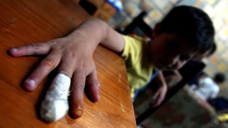 A 11 subió el número de personas quemadas con pólvora en lo corrido del mes de diciembre de este año en el departamento del Cauca. Foto: Colprensa