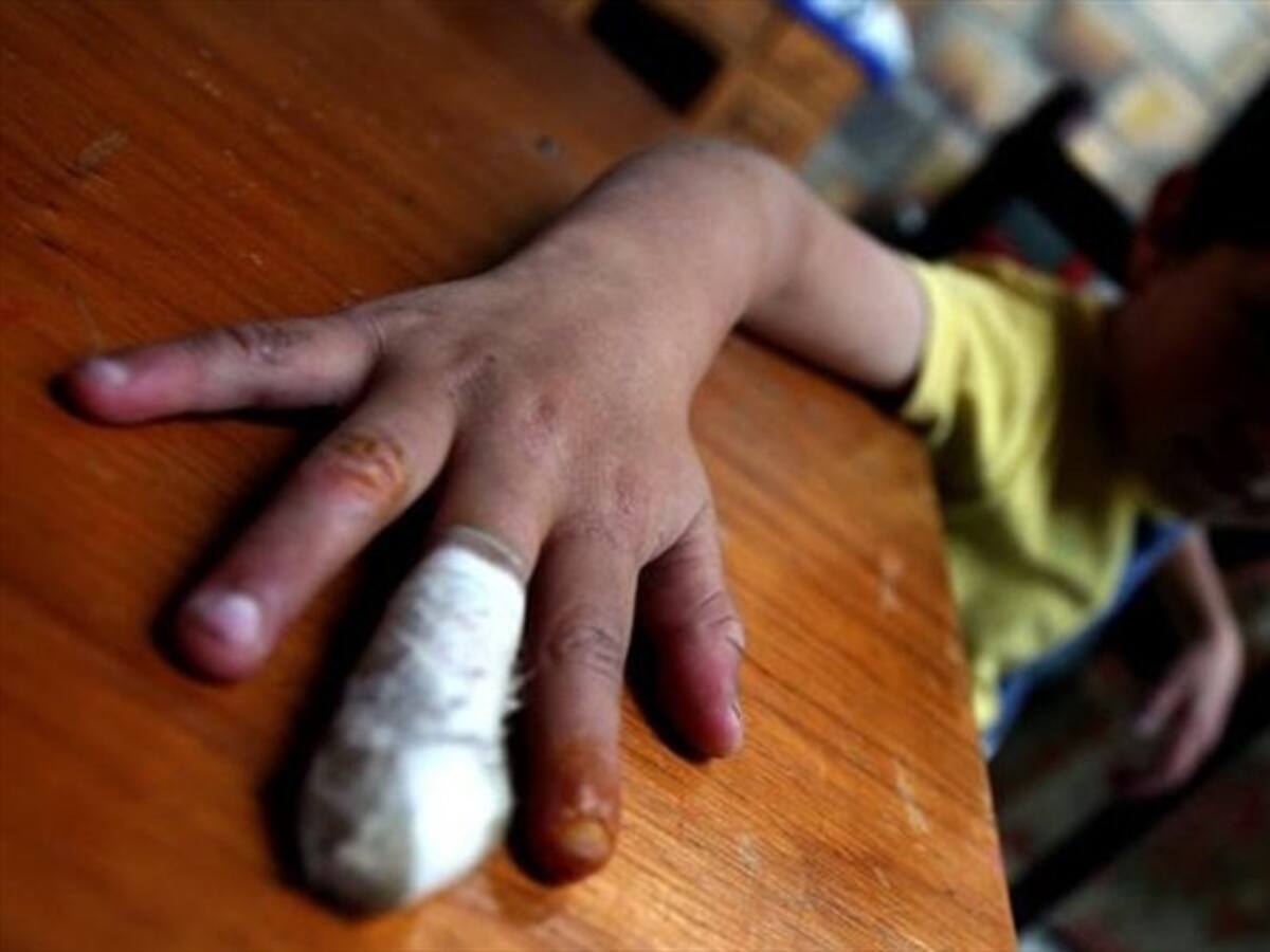 Sube a 11 el número de quemados con pólvora en Cauca