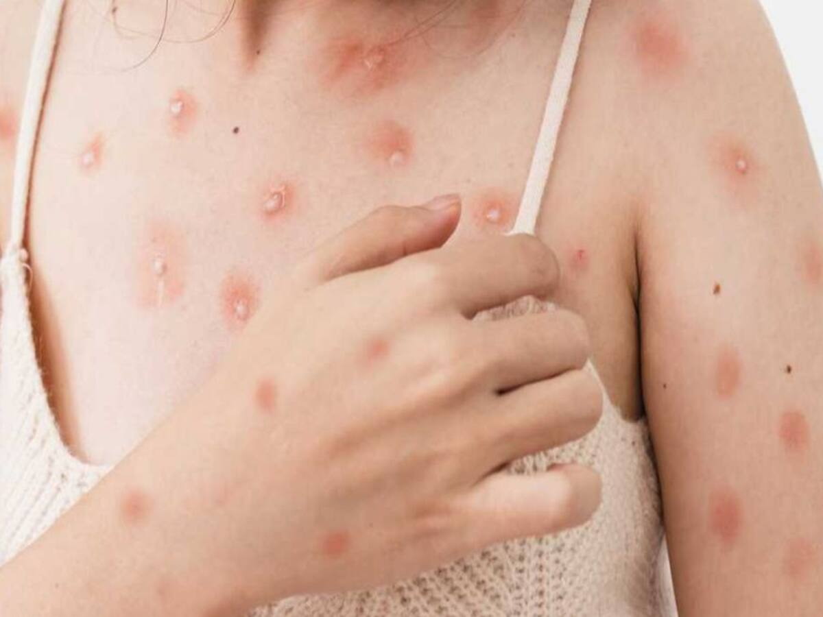Ya van 8 casos de viruela símica en Santander