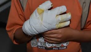 Según el Observatorio de Salud del Valle, diez municipios, exceptuando Cali, reportan en el inicio de la temporada decembrina 10 menores lesionados por la manipulación inadecuada de pólvora.