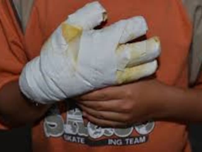 Según el Observatorio de Salud del Valle, diez municipios, exceptuando Cali, reportan en el inicio de la temporada decembrina 10 menores lesionados por la manipulación inadecuada de pólvora.