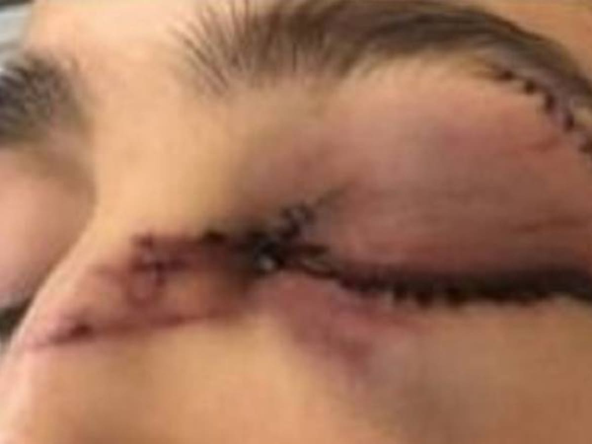 A cirugía mujer golpeada brutalmente por su esposo en Barranquilla