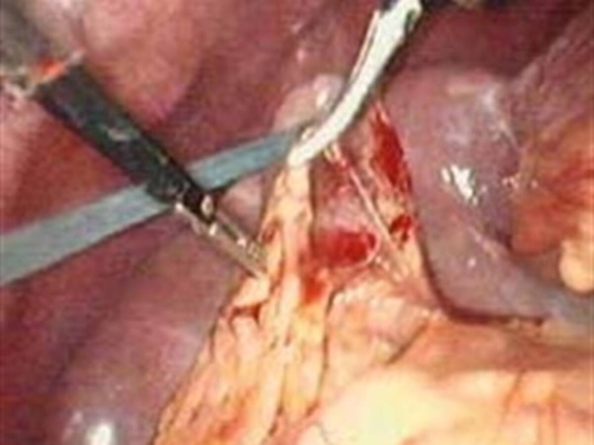 Colombia, líder en cirugía de cáncer gástrico