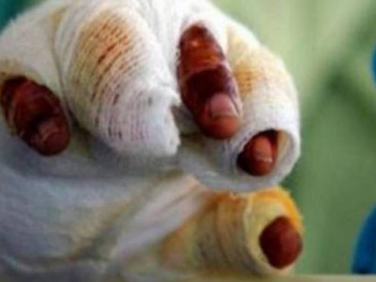 El Quindío reporta una reducción del 70% en número de lesionados por pólvora