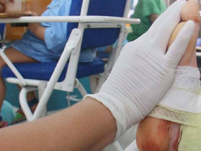 Pabellón de quemados en Antioquia está completamente lleno