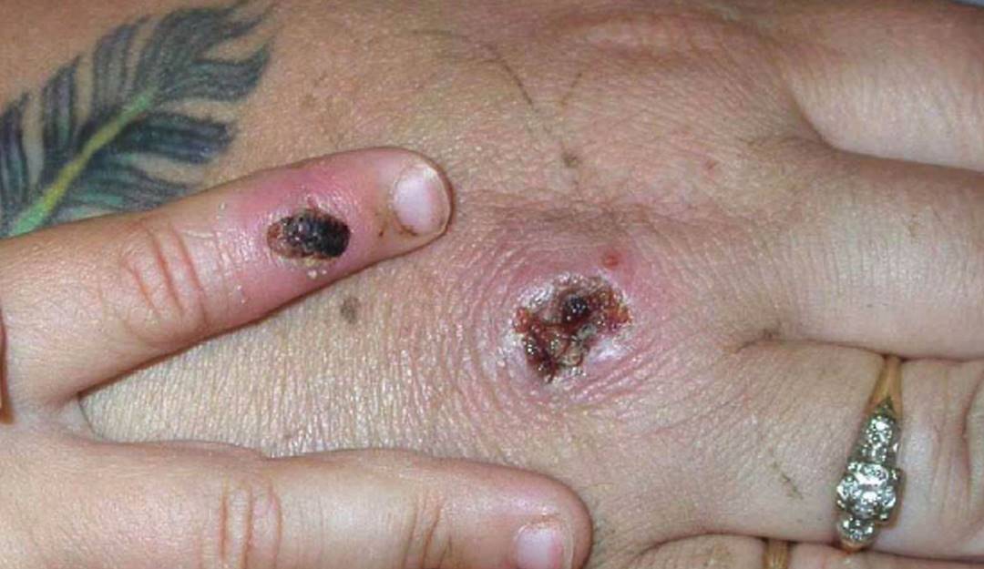 Lesiones en la piel tras contagio con viruela del mono.              Foto: Getty 