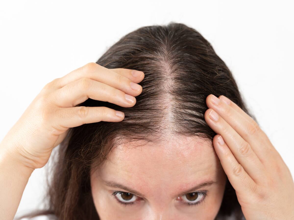 ¿Por qué se cae el cabello? conozca las causas y tratamientos contra la alopecia, hablan los médicos
