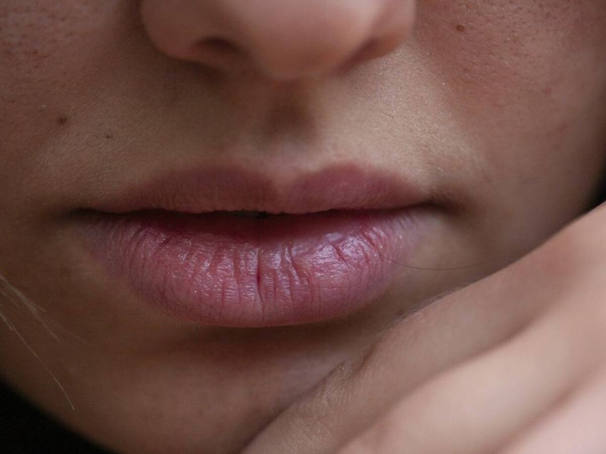 ¿Cómo es la vida de los pacientes con psoriasis?