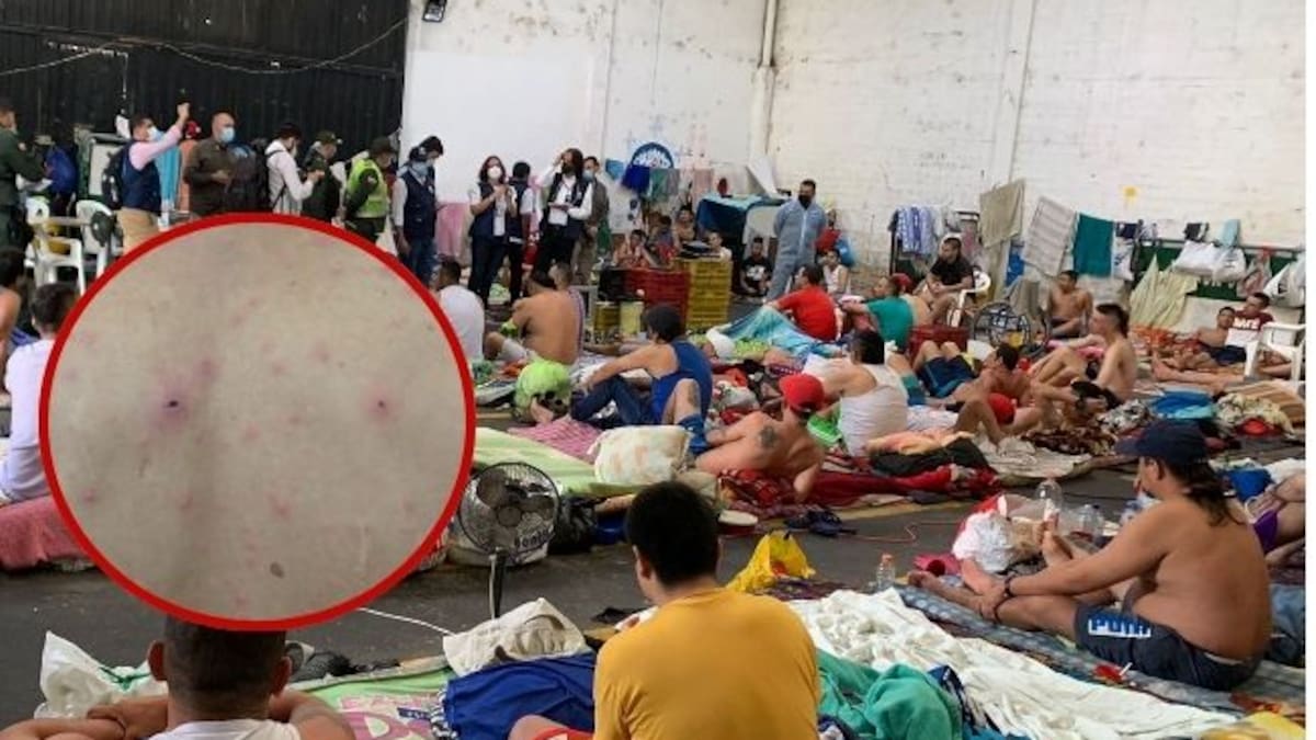 A 23 se elevan los casos de varicela en la cárcel de varones La 40 de Pereira