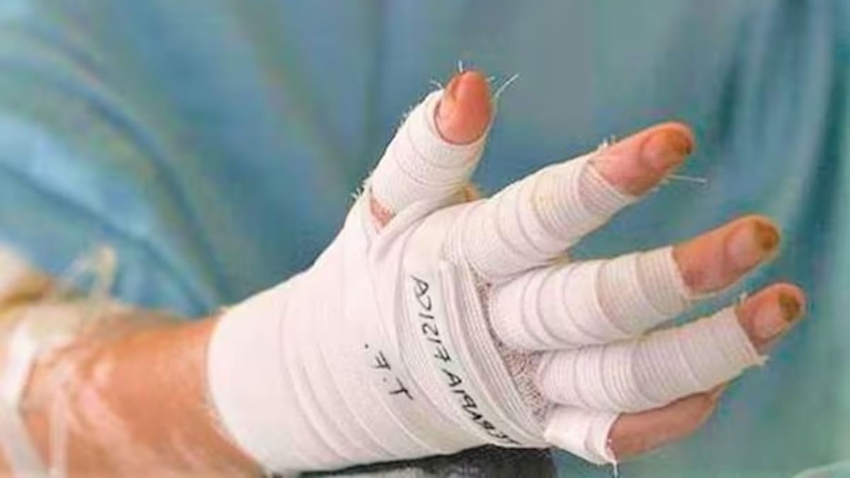 Manizales reporta el primer caso de una persona quemada por pólvora en diciembre