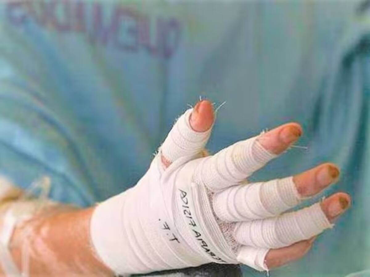 Manizales reporta el primer caso de una persona quemada por pólvora en diciembre