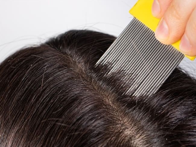 Foto de referencia de una mujer tratando los piojos a una niña. Foto: Getty Images/Zarina Lukash