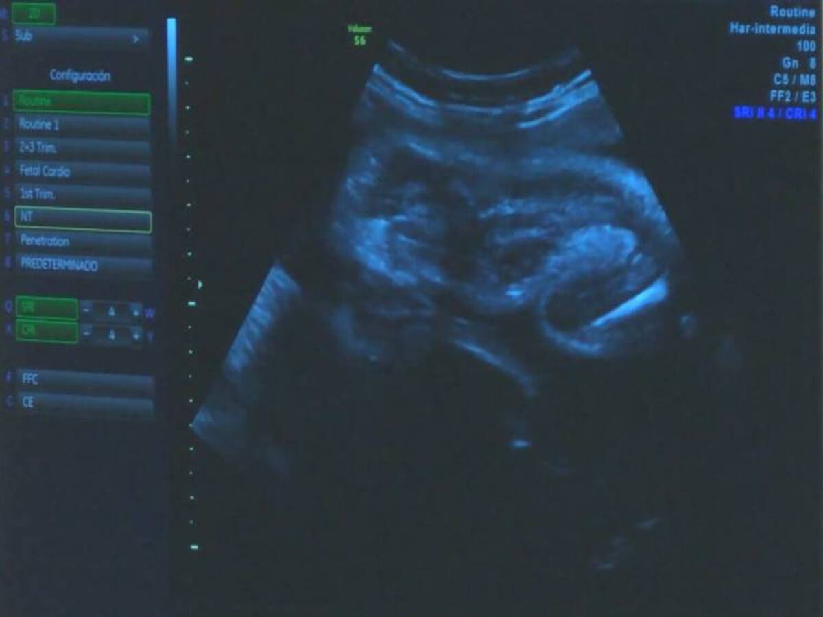 ¿Qué es la ecocardiografía?