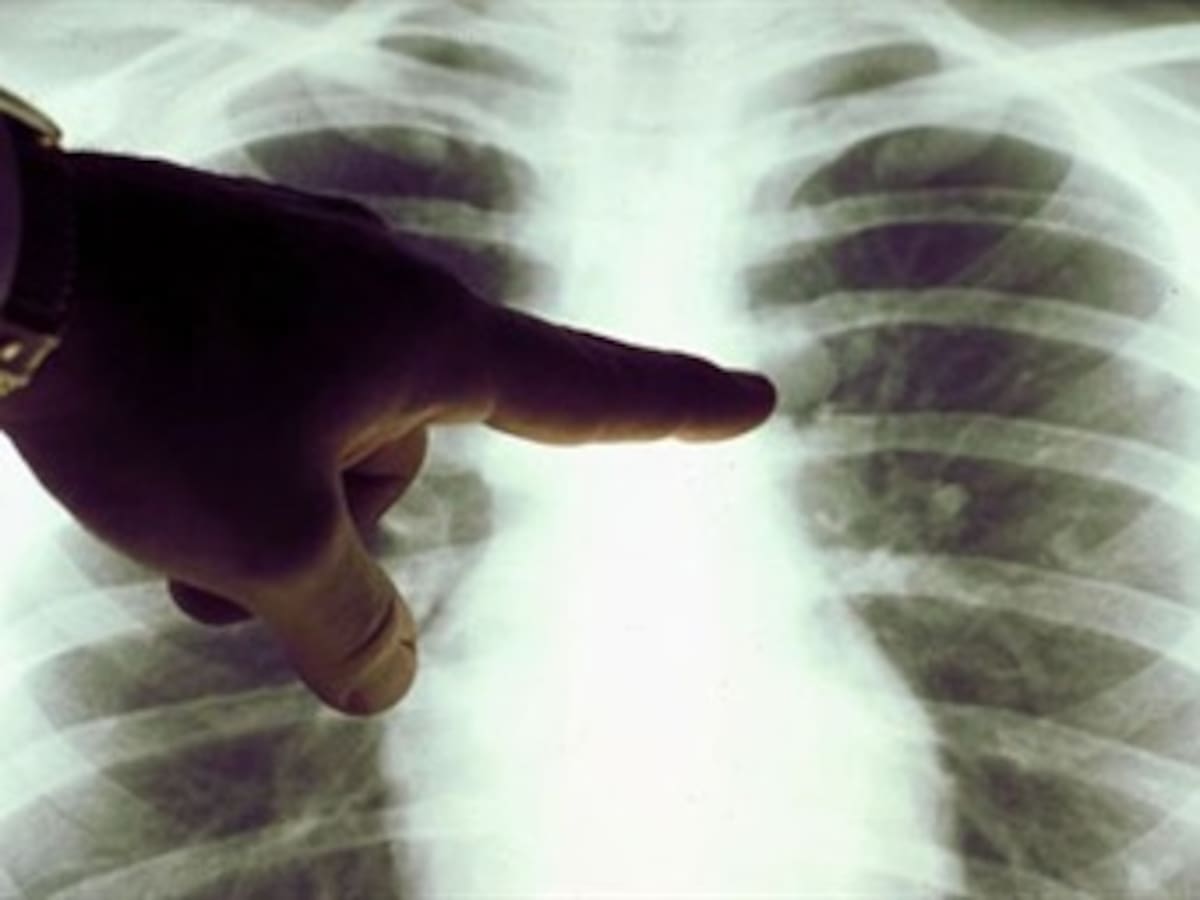 Nuevo mecanismo para identificar cáncer de pulmón