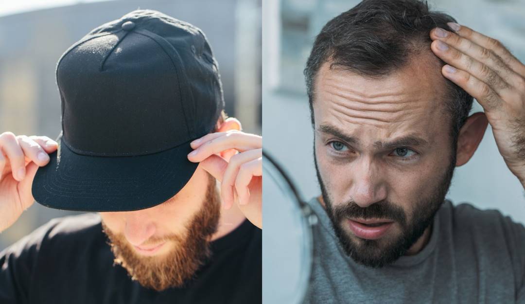 Alopecia - Getty Images