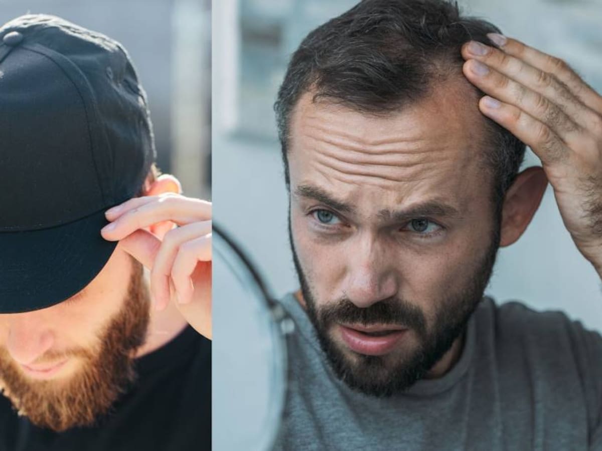 Por qué usar gorra es malo para las personas que se le está cayendo el cabello