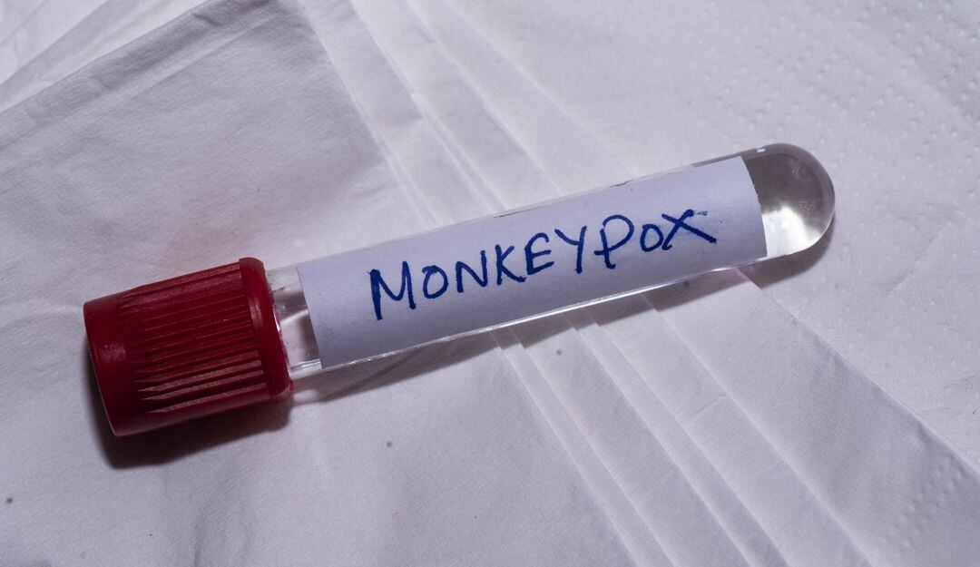 Viruela del mono en Colombia hoy: número de casos actualizado