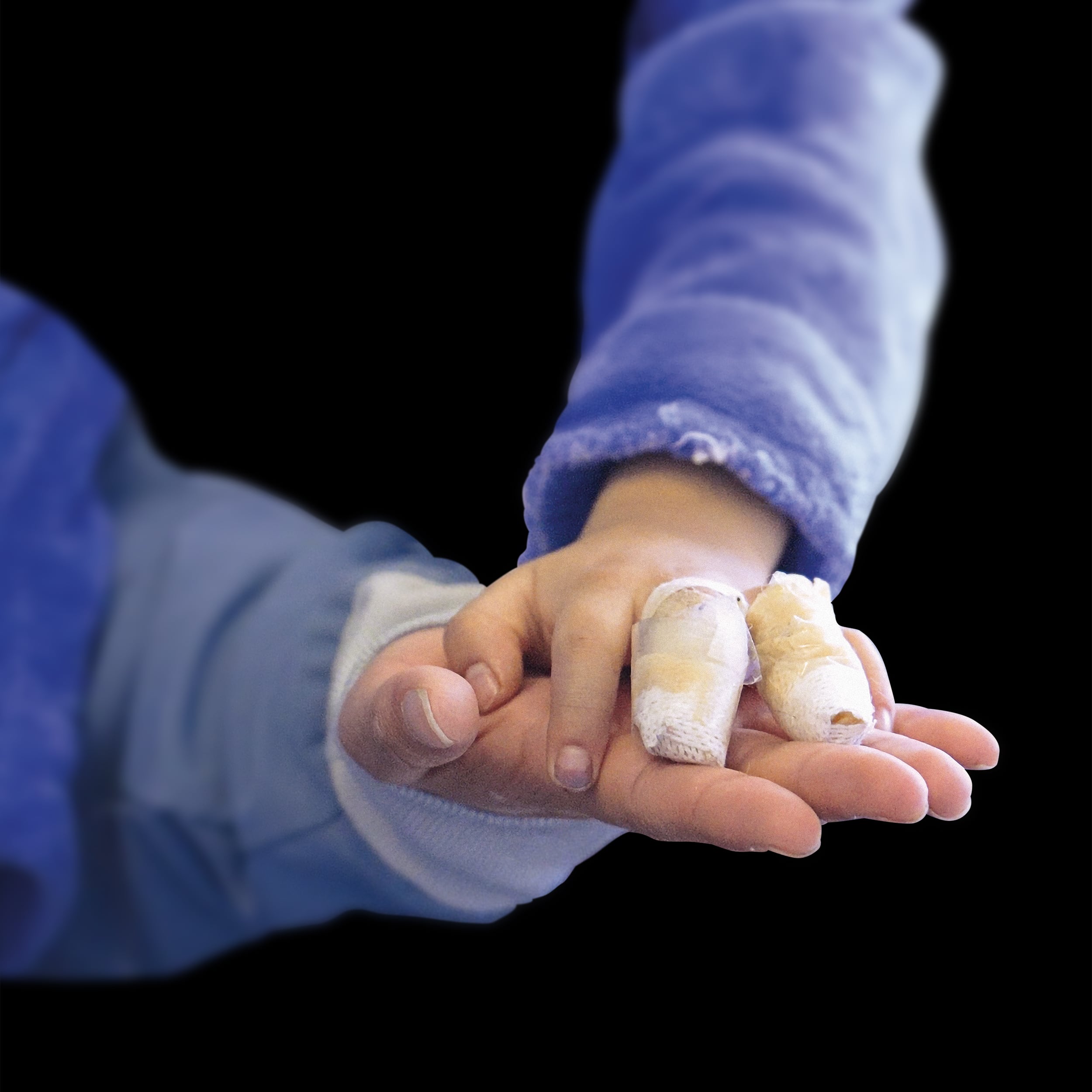 Quemados con pólvora. / Foto: Archivo. 