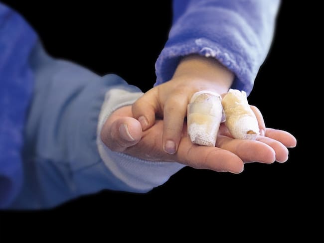 Cifra de quemados con pólvora disminuyó 31,4% en 2025: los datos del Observatorio de Salud de Bogotá