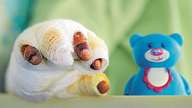 ¡Lamentable! Colombia superó la cifra de quemados por pólvora de 2020 y 2019 con más de 371 casos