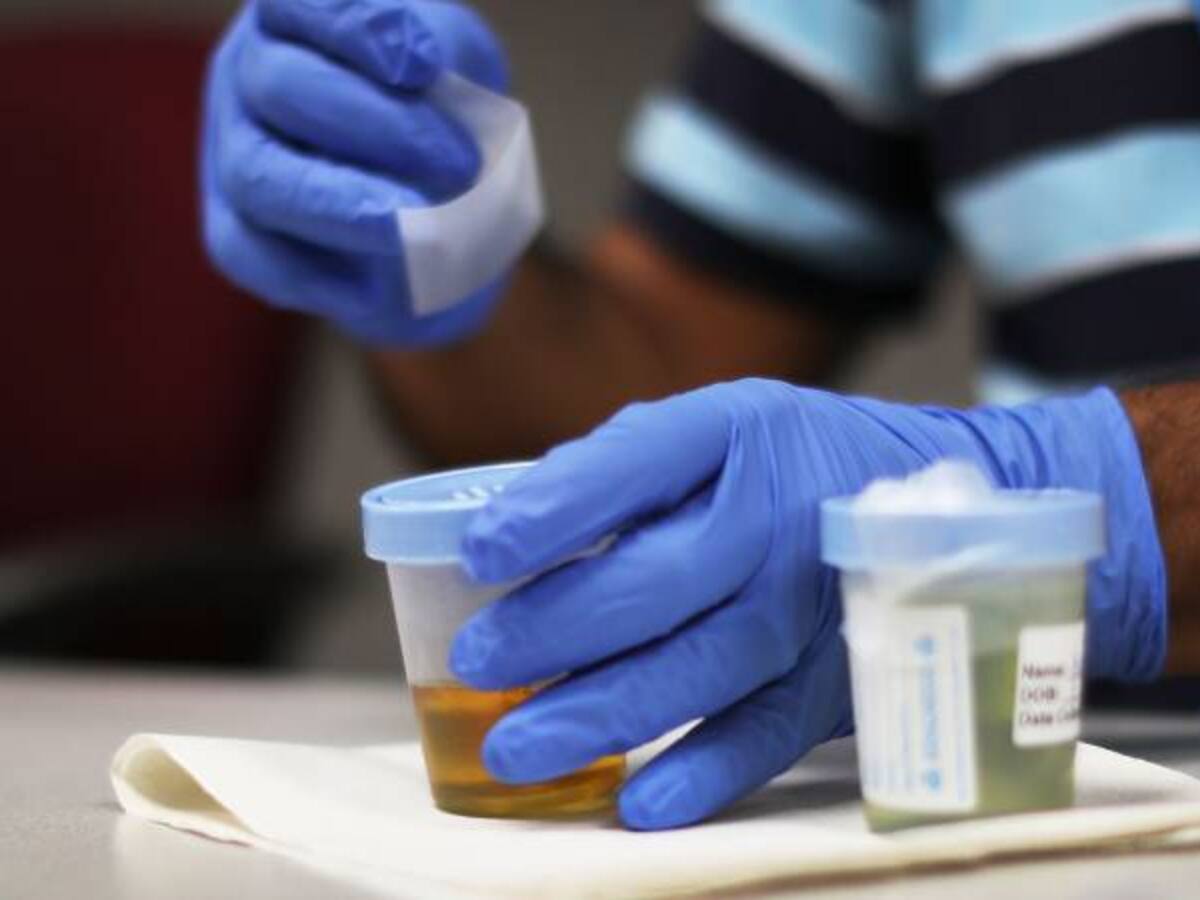 Desarrollan novedoso análisis de orina para detección de cáncer de vejiga
