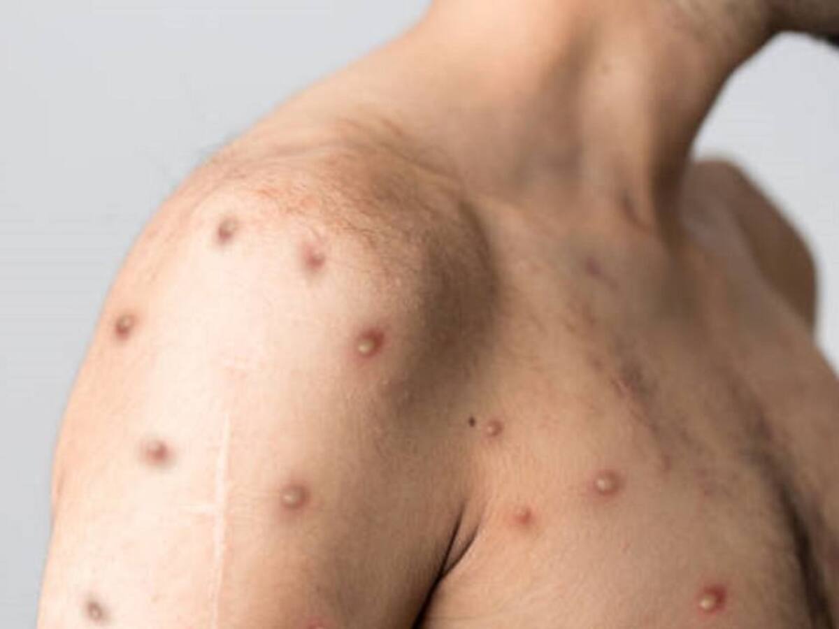 Reportan al parecer primer caso de viruela del mono en el Huila