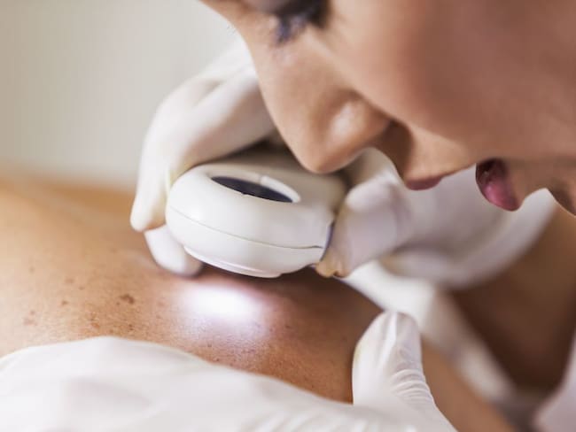 ¿Cómo prevenir el cáncer de piel? Una de las enfermedades más comunes