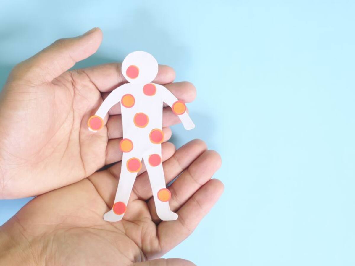 Viruela del mono: ¿Cuál es su origen y cómo me puedo contagiar?