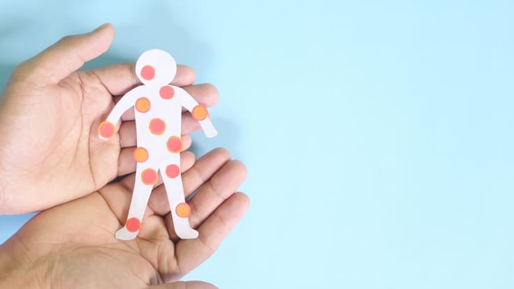 ¿Cómo se puede contagiar por la viruela del mono?