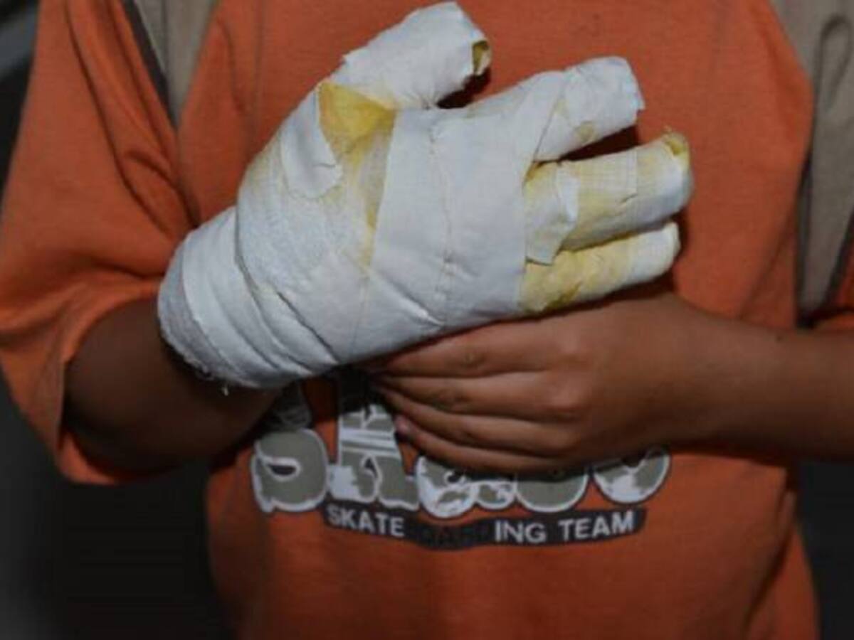 2017 cerró con incremento de casos de quemados con pólvora en Risaralda