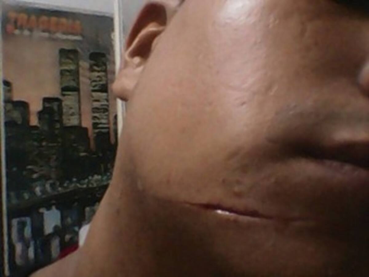 Por intolerancia un joven fue desfigurado con un machete‏ en Cali