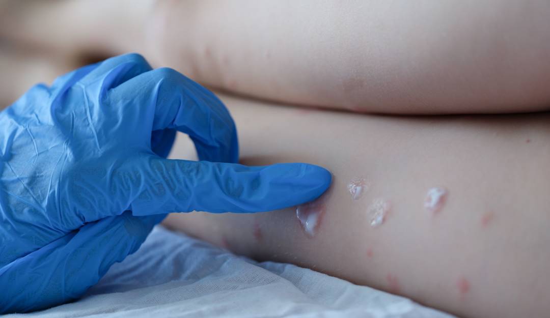 Colombia superó los 500 casos de Viruela del Mono. Foto: Getty Images. 