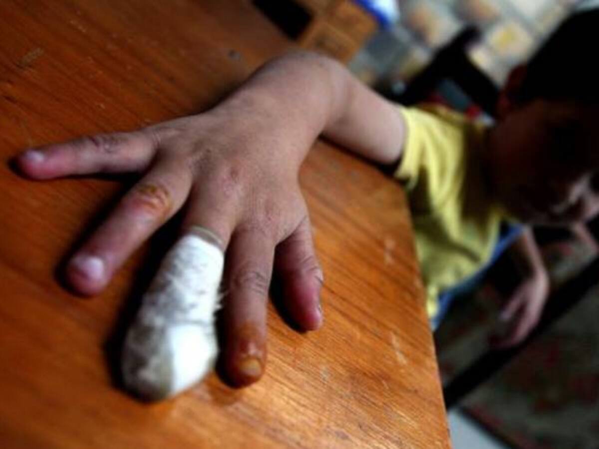 Bogotá es la ciudad con menos niños quemados por pólvora