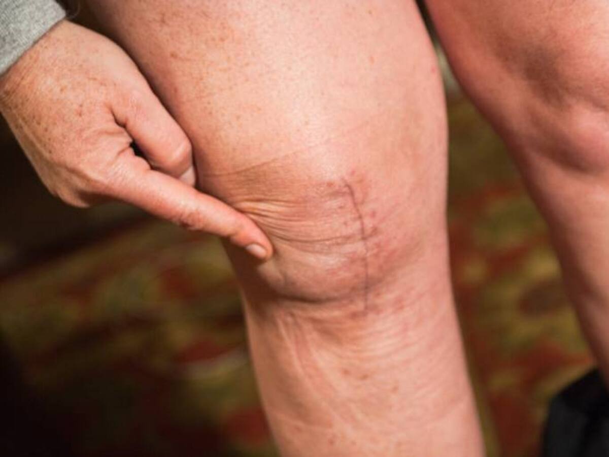 Mitos y verdades sobre las cicatrices