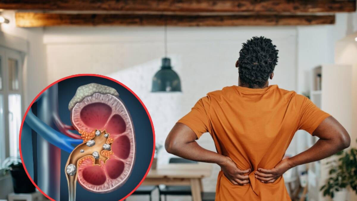 ¿Se pueden eliminar las piedras en los riñones de forma natural? Consultamos a nefrólogo