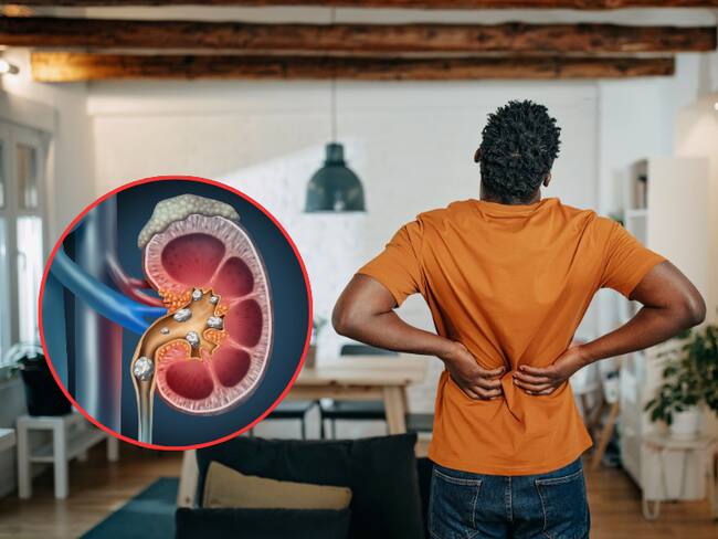 Hombre sufriendo por dolores en la espalda / Riñones con cálculos renales (Getty Images)