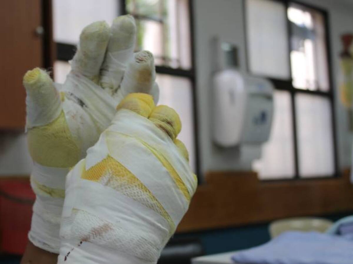 Reportan 232 quemados con pólvora en Antioquia en la temporada diciembre–enero