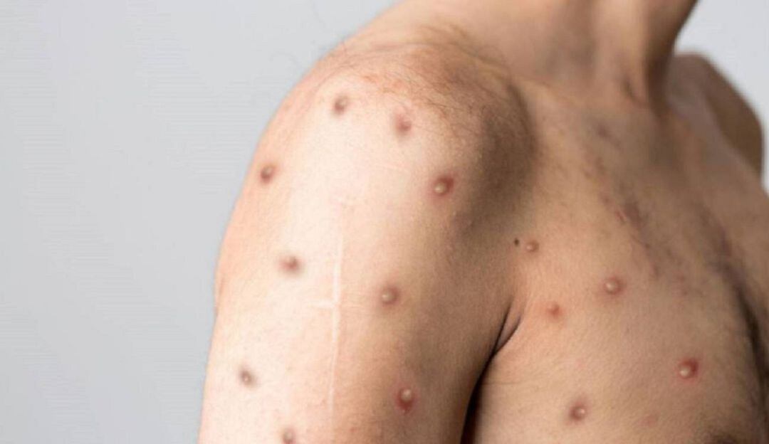 Primer caso viruela del mono en Norte de Santander