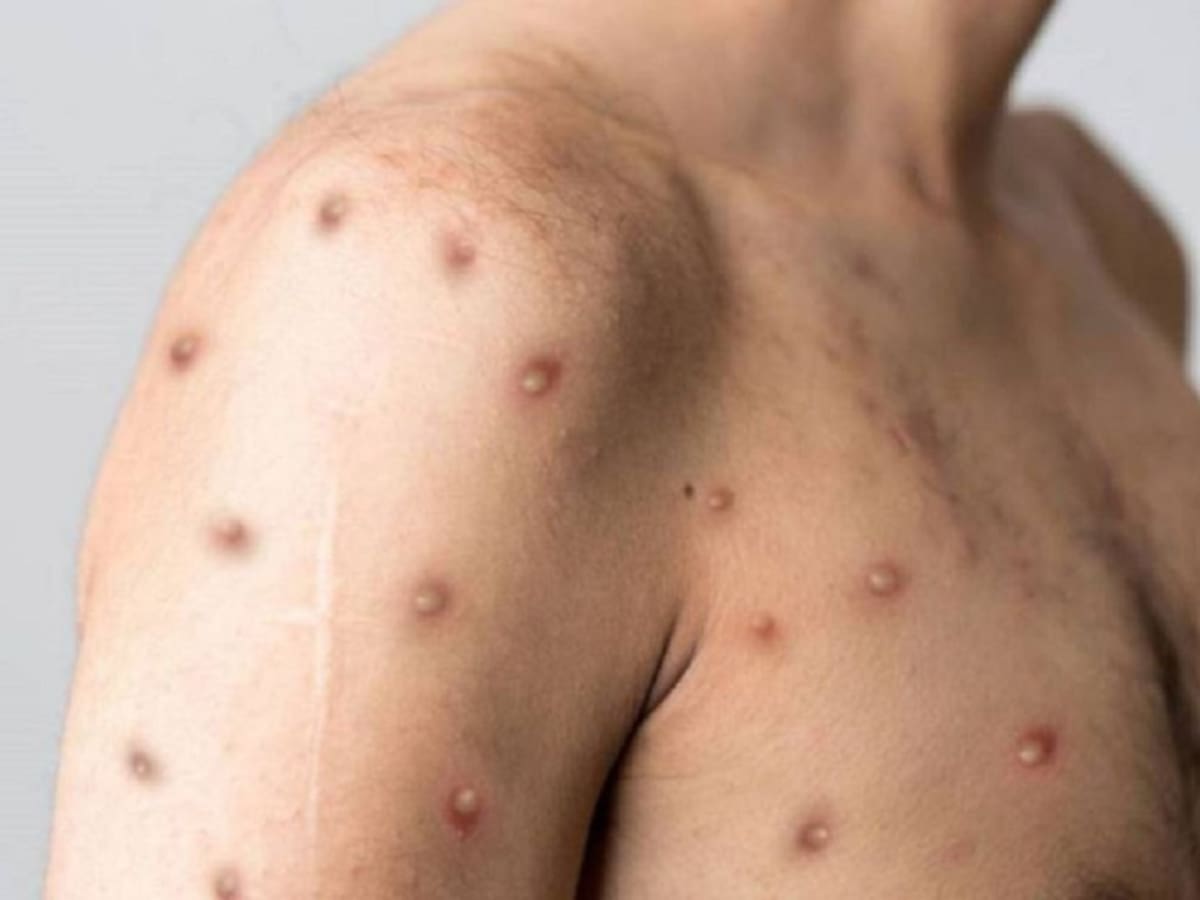 Primer caso viruela del mono en Norte de Santander