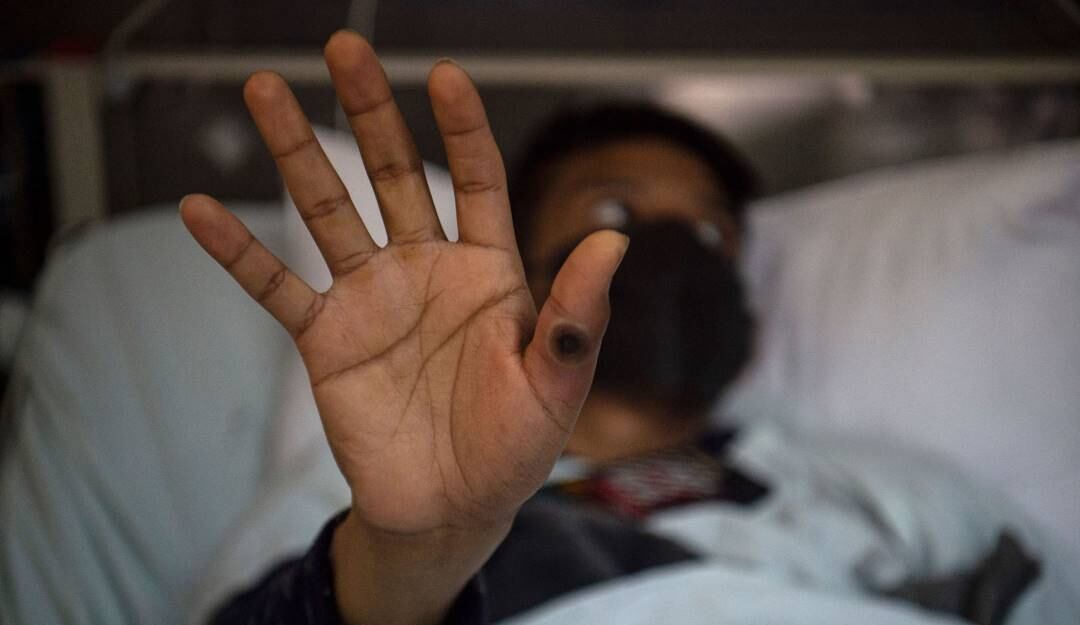 Heridas en la piel tras contagio con la viruela del mono.          Foto: Getty 