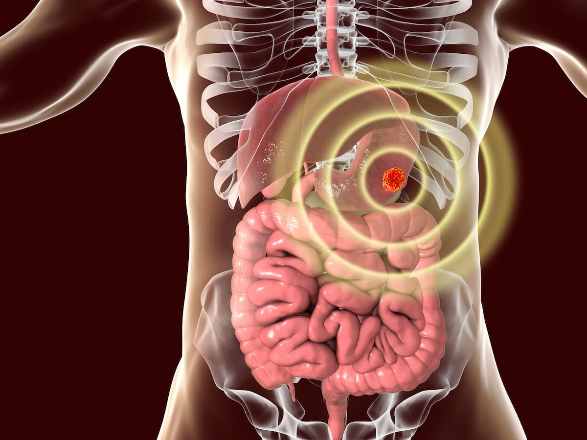 Cuide su salud: estos síntomas podrían sugerir un cáncer de estómago
