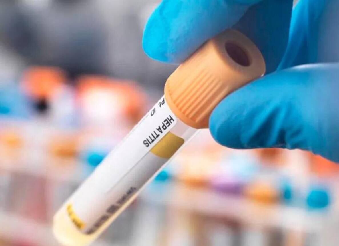 Hepatitis A / Foto: Getty Images