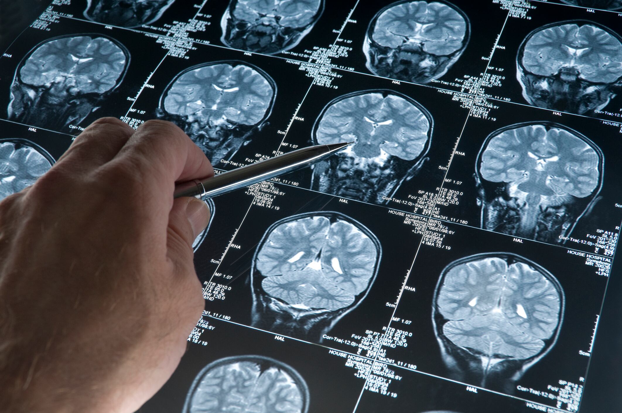 Tumores cerebrales, imagen de referencia.