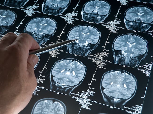 Tumores cerebrales, imagen de referencia.