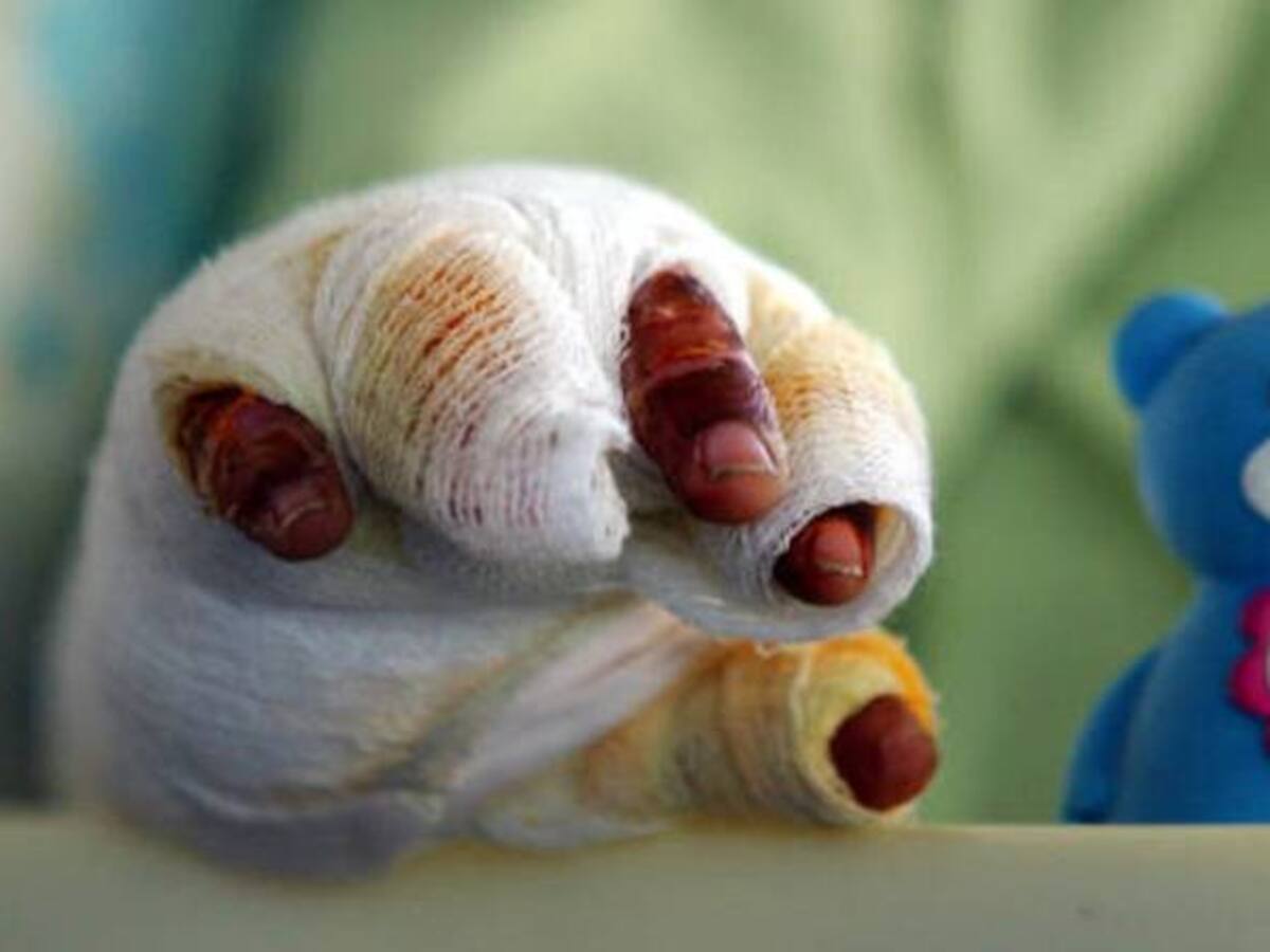 En Piendamó Cauca ya se reporta el primer caso de niños quemados con pólvora