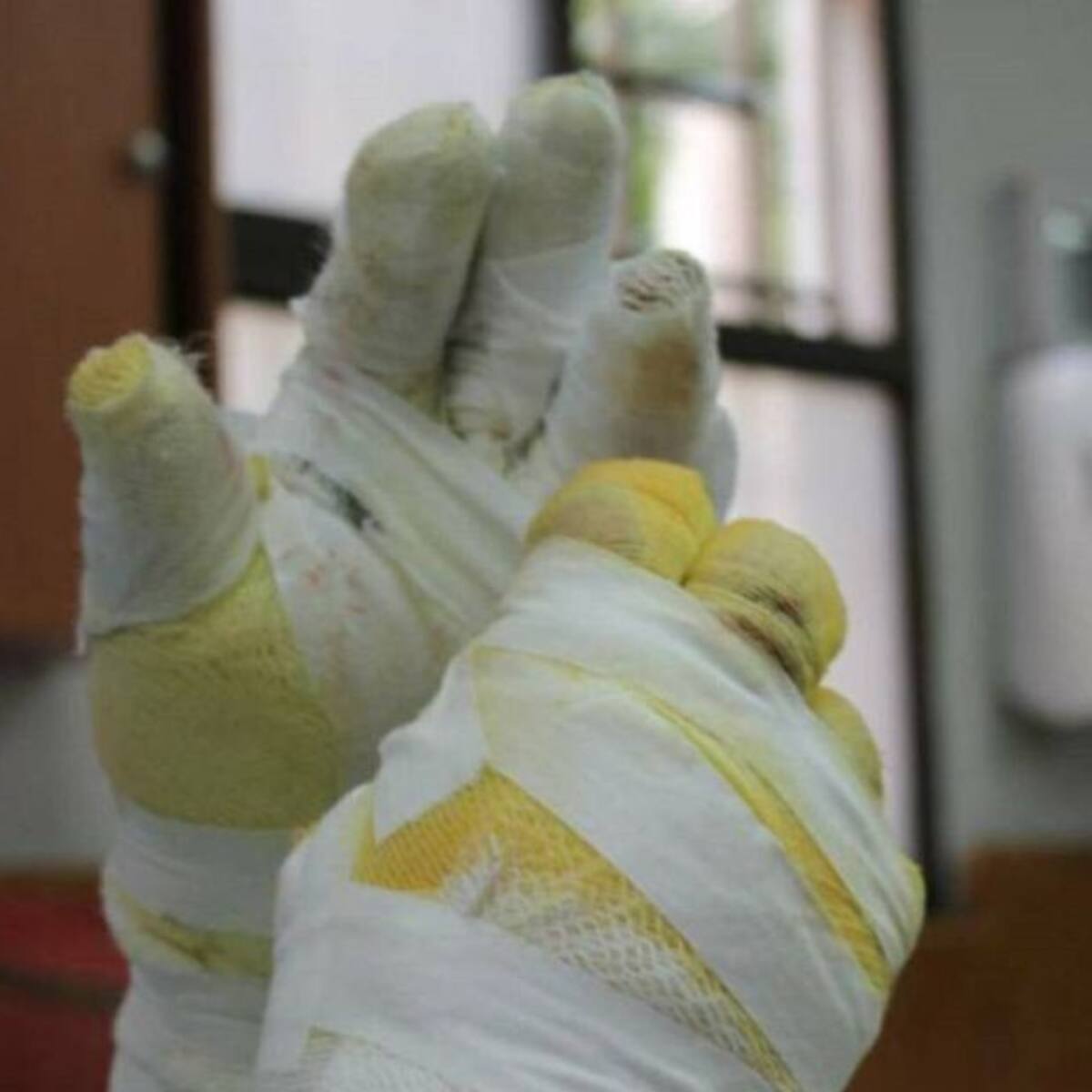 A 6 asciende la cifra de quemados por pólvora en el Quindío