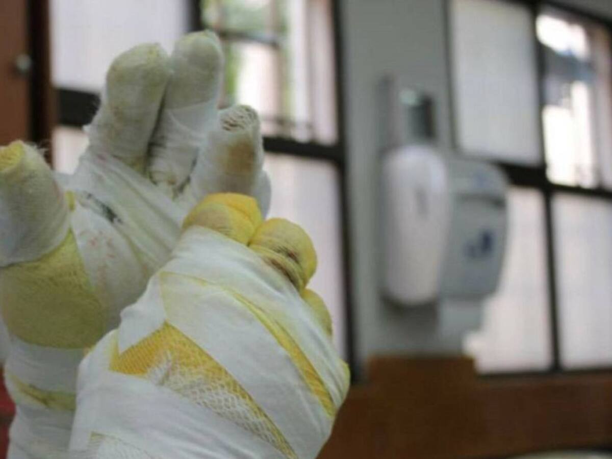 A 6 asciende la cifra de quemados por pólvora en el Quindío